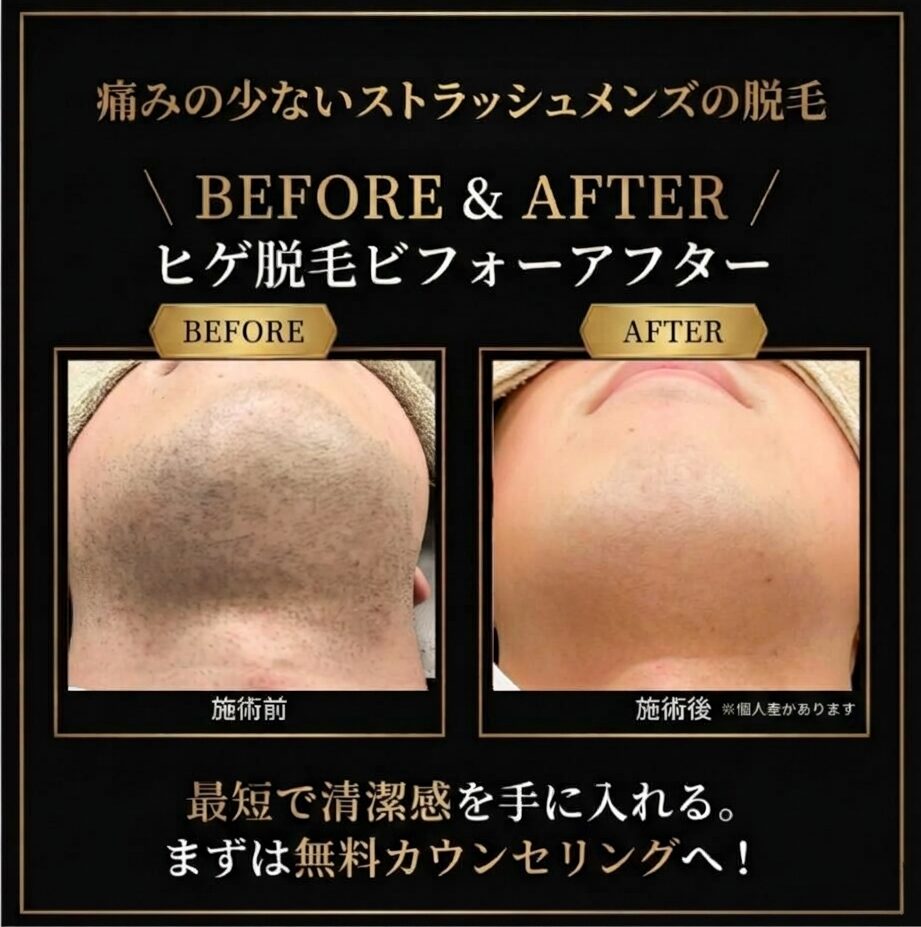 ヒゲ脱毛のビフォーアフター(あご下)